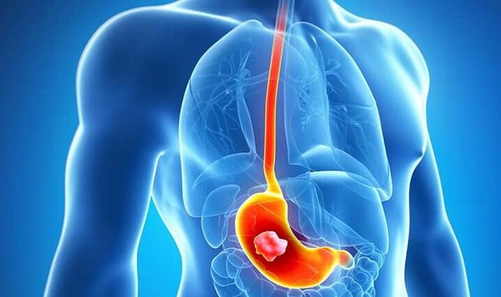 If you have a stomach ulcer, adhering to the Dukan diet is contraindicated.