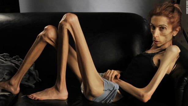 anorexia